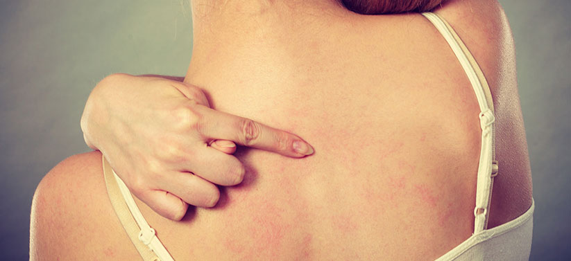 Allergitest vid misstanke om allergi